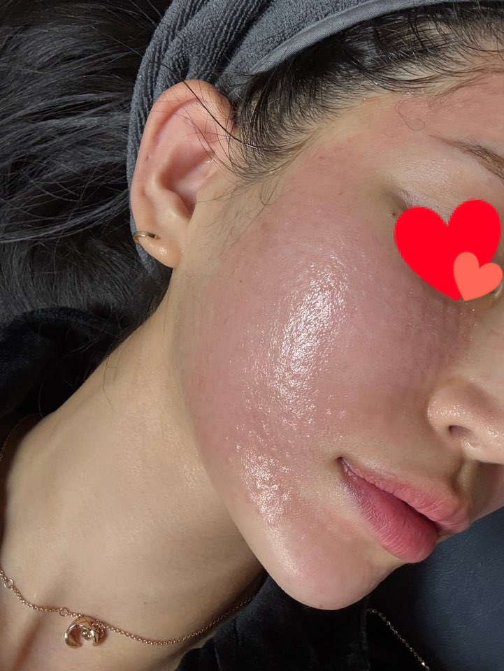 리쥬란힐러 직후