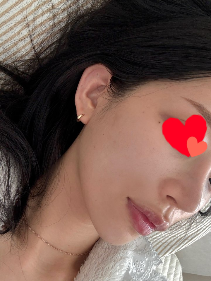 리쥬란힐러 에프터